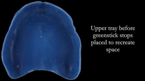 Newsletter 53 showing the making and fitting of ultra life-like dentures for Valena