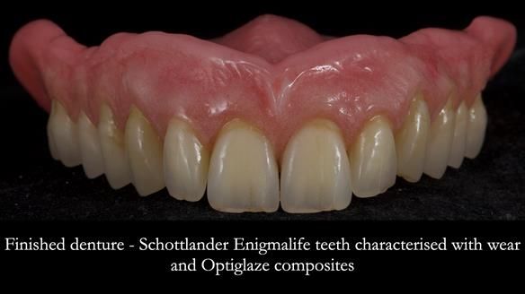 Newsletter 80 - Gordon’s dentures: the one case in 1,000 where my technique failed