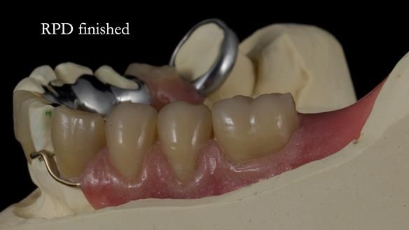 Newsletter 55 Provision of metal based partial dentures for Zephyrine with a repaired cleft lip and palate