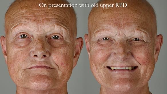 Newsletter 81 - Pam’s Story — how a partial denture changed her life (+ live walkthrough this Thursday)