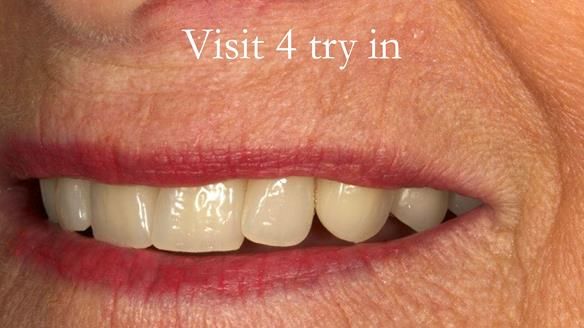 Visit 4 - The patient assesses the try in