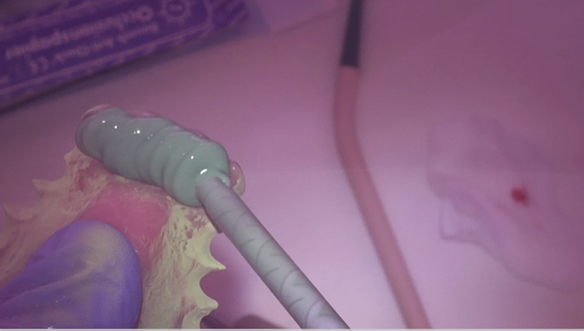 Figure 31 Light bodied silicone wash to check the soft tissue fitting surface.