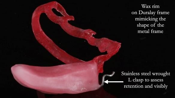 Finlay's Newsletter 61 provision of a lower unilateral free end saddle metal based partial denture for Joyce