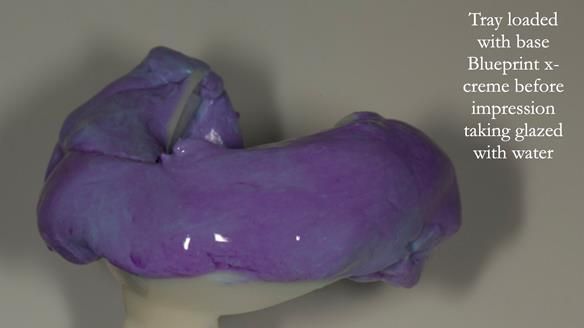 Newsletter 75: Marion’s case - Step-by-step complete denture workflow