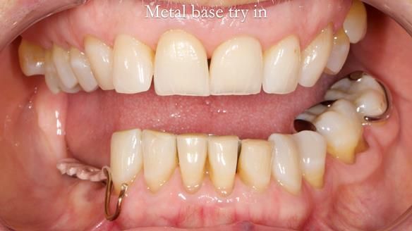 Finlay's Newsletter 61 provision of a lower unilateral free end saddle metal based partial denture for Joyce