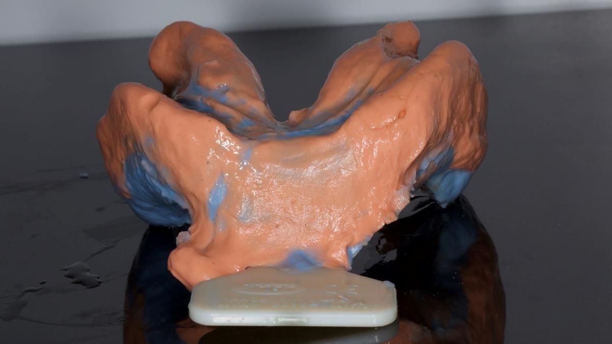 Fin’s Newsletter 88 — Complete dentures - full protocol… he rearranged his own teeth!