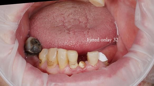 Newsletter 55 Provision of metal based partial dentures for Zephyrine with a repaired cleft lip and palate