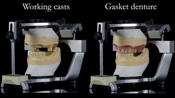 Finlay's Newsletter 58 Gasket upper partial denture for Zoe