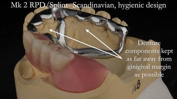 Newsletter 51 Managing Anne’s failing dentition with distal extension base RPD/Splint FULL PROTOCOL