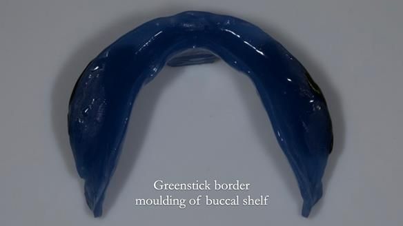 Newsletter 83: Sheila’s Complete Denture Success