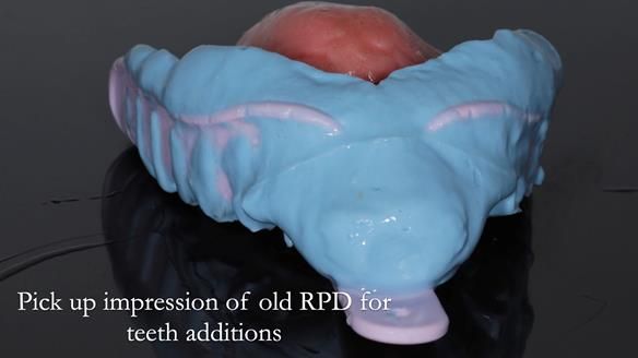 Finlay's Newsletter 62 provision of extractions and metal based complete dentures for Rafique