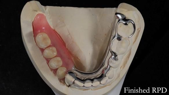 Finlay's Newsletter 61 provision of a lower unilateral free end saddle metal based partial denture for Joyce