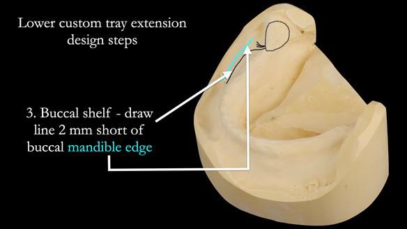 Newsletter 50 Special edition Complete Dentures FULL PROTOCOL