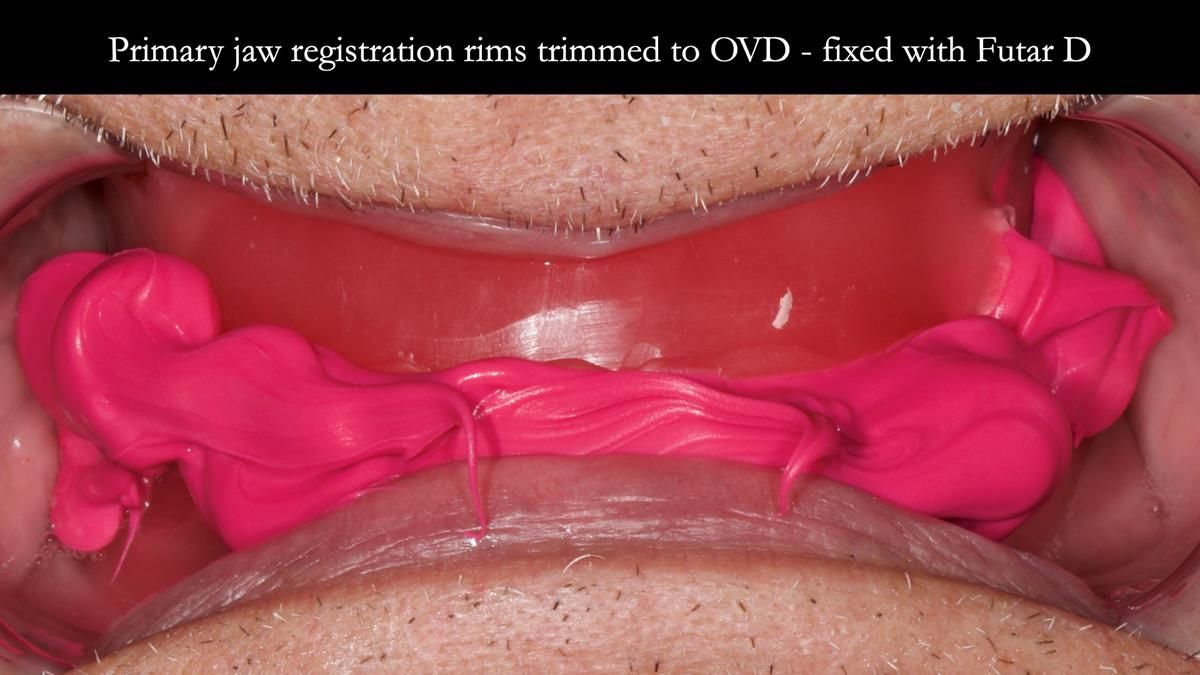 Fin’s Newsletter 88 — Complete dentures - full protocol… he rearranged his own teeth!