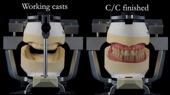 Newsletter 50 Special edition Complete Dentures FULL PROTOCOL