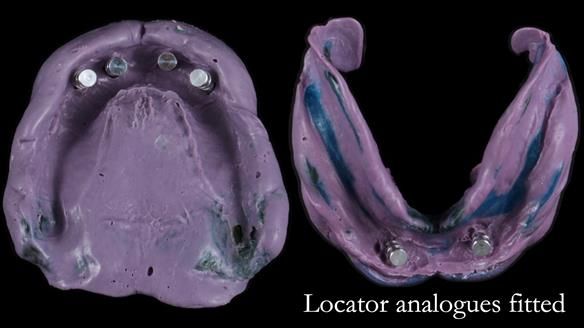 Newsletter 65 Marisa Provision of Complete Dentures on badly placed implants