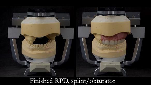 Upper metal base partial denture/occlusal stabilisation splint/obturator - full protocol