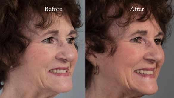 Newsletter 75: Marion’s case - Step-by-step complete denture workflow