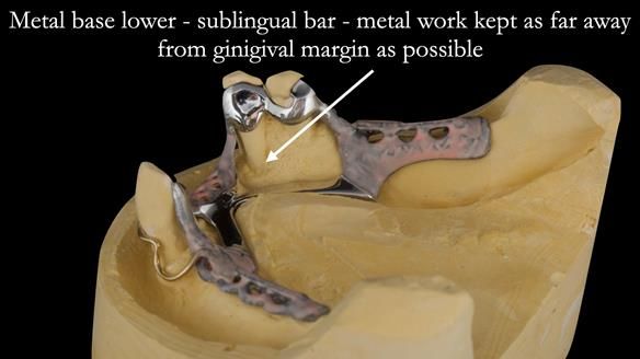 Finlay's Case Study Newsletter 40 - Immediate Mk 1 RPD to Definitive Mk 2 RPD - full protocol