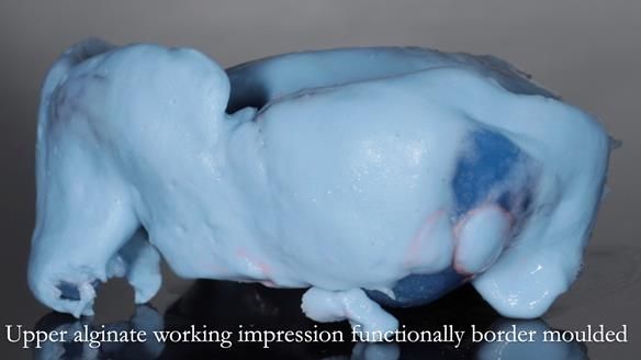 Finlay's Newsletter 58 Gasket upper partial denture for Zoe