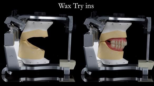 Replacing Madeline’s Complete denture FULL PROTOCOL