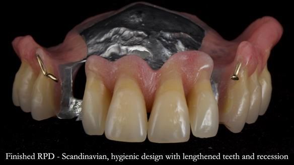 Finlay's Newsletter 59 Ultra hard partial dentures made for Gill