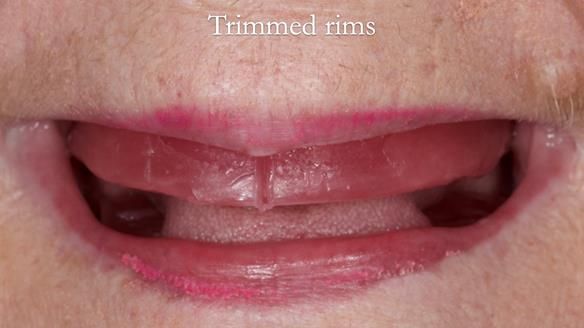 Replacing Madeline’s Complete denture FULL PROTOCOL