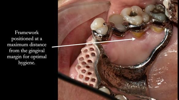 Finlay's Newsletter 63 Case study provision of metal based Scandinavian RPD - functional 10 years on