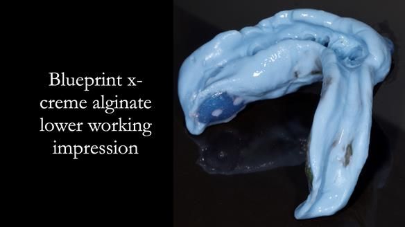 Newsletter 55 Provision of metal based partial dentures for Zephyrine with a repaired cleft lip and palate