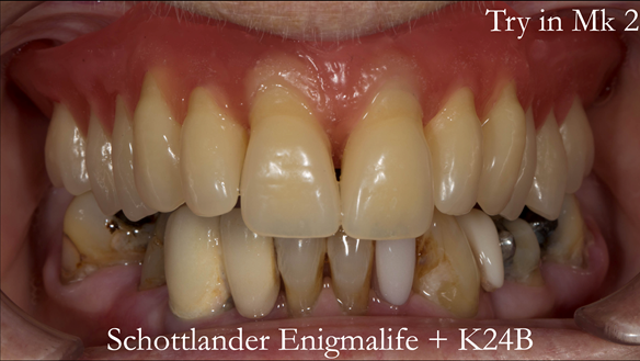 Figure 91 Mk 2 teeth wax try in with Schottlander Enigmalife teeth in mouth in centric relation position