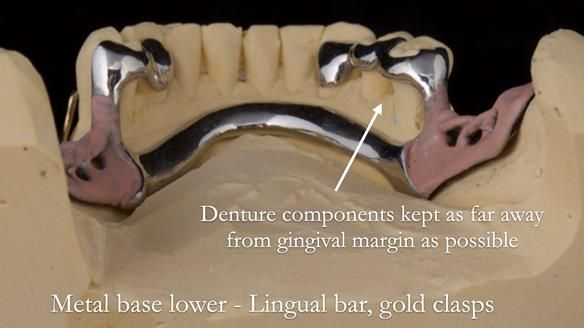 Solving Linda’s Failed “All on 4” implant bridges - full protocol Newsletter 42