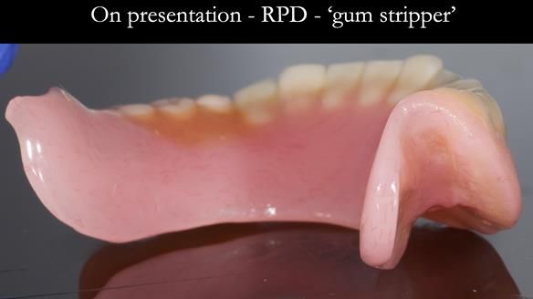 Finlay's Newsletter 59 Ultra hard partial dentures made for Gill