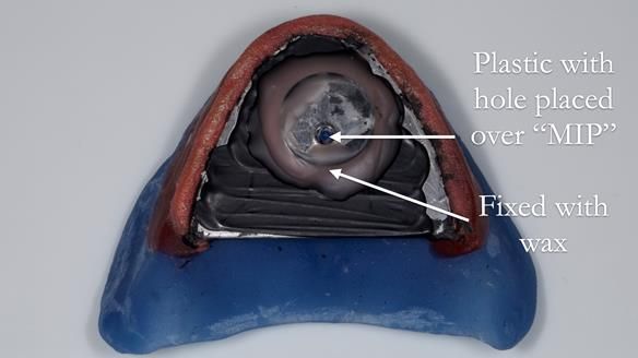 Newsletter 80 - Gordon’s dentures: the one case in 1,000 where my technique failed