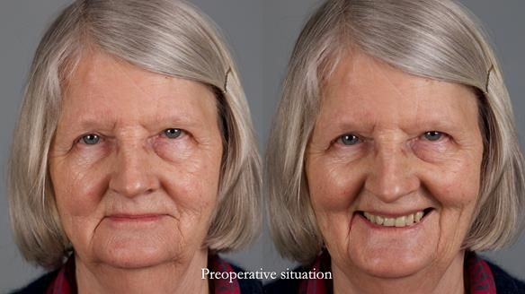 Newsletter 82 Mary - A complete upper and a one-tooth gasket denture