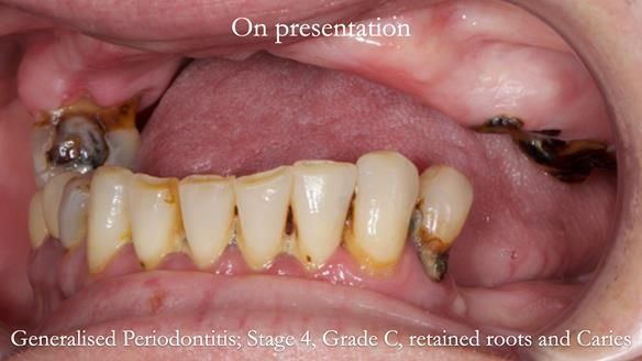 Newsletter 52 Managing Jo’s failing dentition with extractions and Mk 1/Mk 2 complete upper dentures and lower partial dentures FULL PROTOCOL