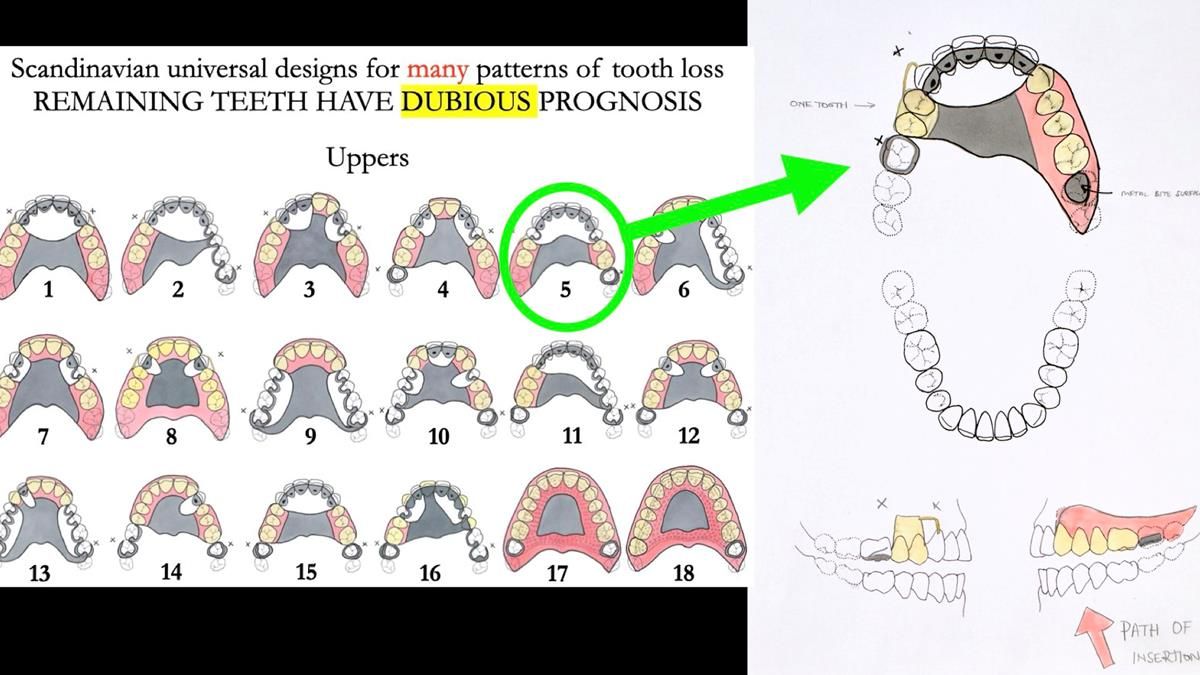 Newsletter 89 – Simon: A Challenging Kennedy Class II Division 1 Upper CoCr Partial Denture with a High Smile Line