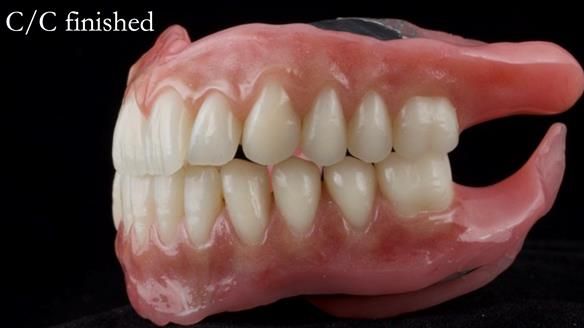 Managing poor implant positioning with complete dentures and Locator attachments - full protocol Newsletter 41