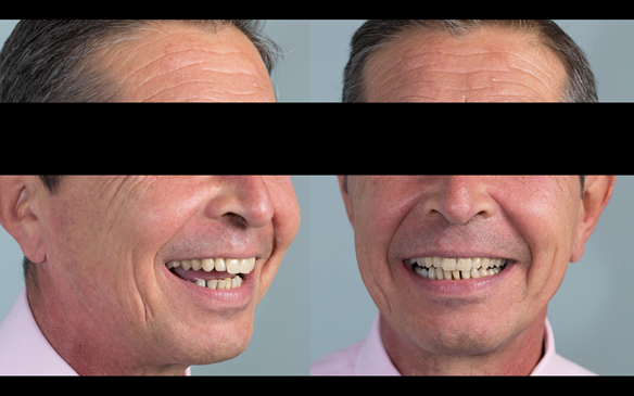 Figure 102 Mk 2 definitive denture try in - at this visit the patient assesses the aesthetics by 1. video, 2. still photographs comparing Mk 1 with Mk 2 and direct observation in a mirror. Only when he was completely happy do we proceed with finishing.