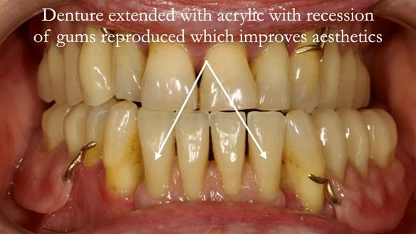 Finlay's Case Study Newsletter 40 - Immediate Mk 1 RPD to Definitive Mk 2 RPD - full protocol