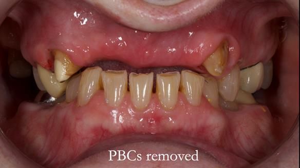 Newsletter 81 - Pam’s Story — how a partial denture changed her life (+ live walkthrough this Thursday)