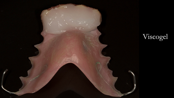 Figure 37 Temporary soft liner Visco-gel mixed ready to be placed in the mouth