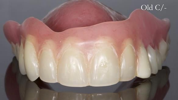 Newsletter 54 case presentation upper complete denture and lower Scandinavian designed hygienic partial denture for David