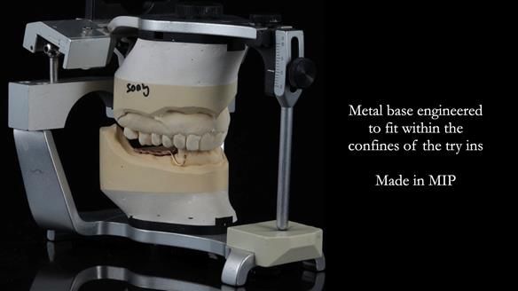 Finlay's Newsletter 61 provision of a lower unilateral free end saddle metal based partial denture for Joyce