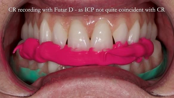 Replacing Madeline’s Complete denture FULL PROTOCOL