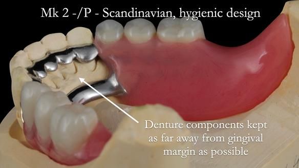 Newsletter 52 Managing Jo’s failing dentition with extractions and Mk 1/Mk 2 complete upper dentures and lower partial dentures FULL PROTOCOL