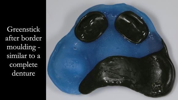 Finlay's Newsletter 58 Gasket upper partial denture for Zoe