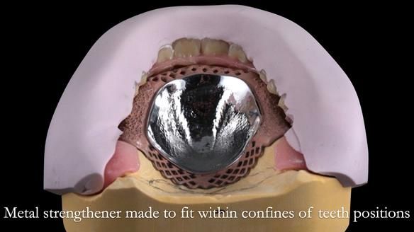 Newsletter 53 showing the making and fitting of ultra life-like dentures for Valena