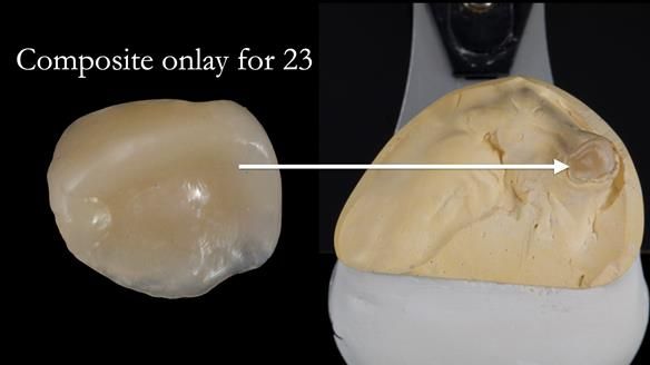 Newsletter 55 Provision of metal based partial dentures for Zephyrine with a repaired cleft lip and palate