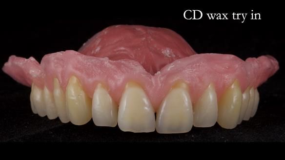 Finlay's Newsletter 62 provision of extractions and metal based complete dentures for Rafique