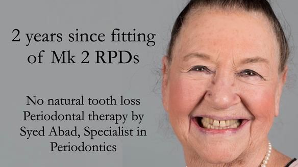 Finlay's Case Study Newsletter 40 - Immediate Mk 1 RPD to Definitive Mk 2 RPD - full protocol